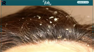 أنواع القشرة.. تعرف على الأسباب والعلاج المناسب لكل حالة بالتفصيل